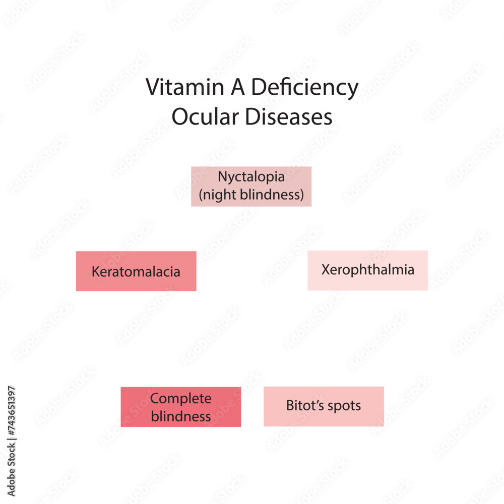Diagram showing Vitamin A deficiency related ocular diseases