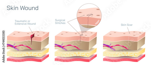 Types of surgical sutures vector illustration. Suture are used by your doctor to close wounds to your skin or other tissues. Thread is attached to a needle to stitch the wound shut.