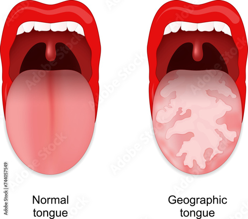 Geographic tongue. Benign migratory glossitis