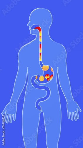 3d animation of esophagus and stomach with gastric reflux and burning. With circles of fire moving upward. Digestive system and human silhouette made of transparent glass on a blue background.