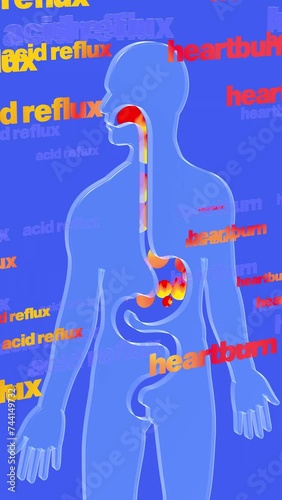 3d animation of esophagus and stomach with gastric reflux and burning. Featuring circles of fire and the words 