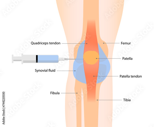 Knee arthrocentesis or synovial fluid aspiration for relieve pain and swelling caused by conditions like arthritis or injury. Medical procedure vector illustration isolated on white background.