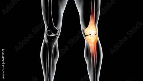Medical Illustration of Male Body Suffering from Knee Injury and Pain