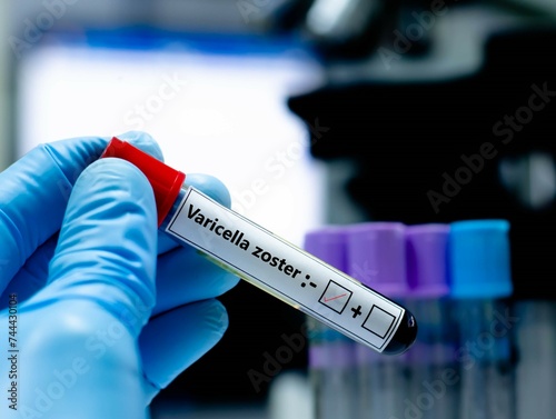 Blood sample of patient negative tested for varicella zoster virus.