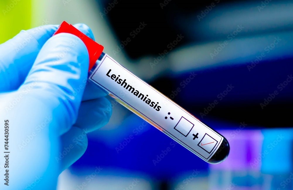 Blood sample of patient positive tested for leishmaniasis. Blood sample of patient positive tested for leishmaniasis.