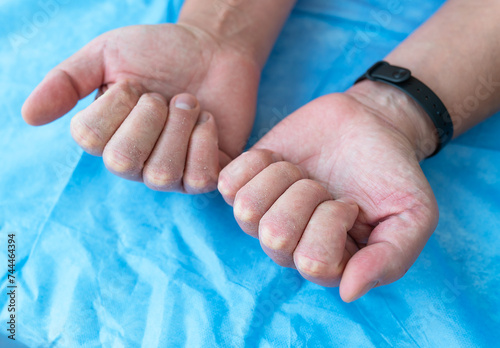 Close-up of hands with very bad skin condition, cracked skin on hands on a blue background. Treatment of dermatitis and psoriasis.