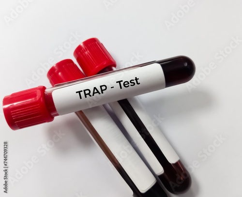 Blood sample for Tartrate resistant acid phosphatase (TRAP) test in laboratory for the diagnosis of hairy cell leukemia. photo