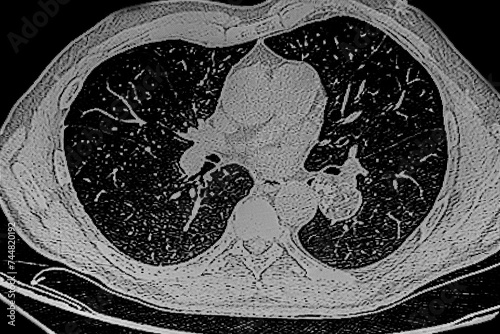 Chest CAT- SCAN that shows a hamartoma tumor on the left lung. Medical themes photo