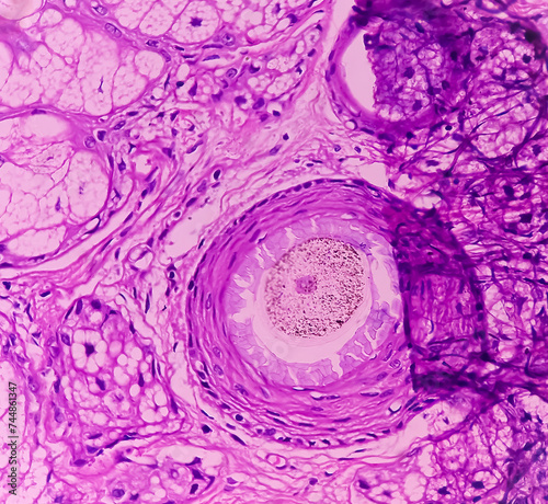 Mature cystic teratoma, Ovarian cyst biopsy, show cyst wall of skin and adnexal structure, fatty tissue, salivary acini and cartilage. Cystic teratoma of dermoid cyst. photo