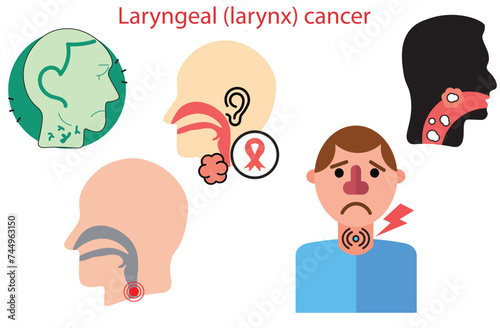 laryngeal (larynx) cancer,Human organ concept. Malignant neoplasm. Sign for web page, Sore loss cough virus viral acute swell sound folds treat cysts Palsy nerve Tumor botox throat hoarse,vectors