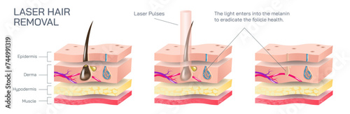 Laser hair removal is a procedure that uses a laser, or a concentrated beam of light on the skin to get rid of hair in the body vector illustration. Skin layers and how laser affects the body hair. photo