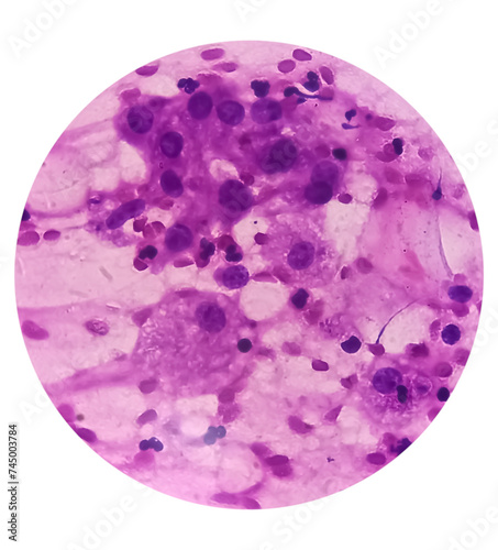 FNA cytology of swelling of chest wall. Infected epidermal inclusion cyst. Commonly called 