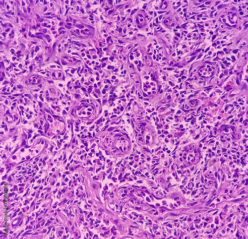 Larynx Cancer. Invasive squamous cell carcinoma. Section show malignant neoplasm. photo