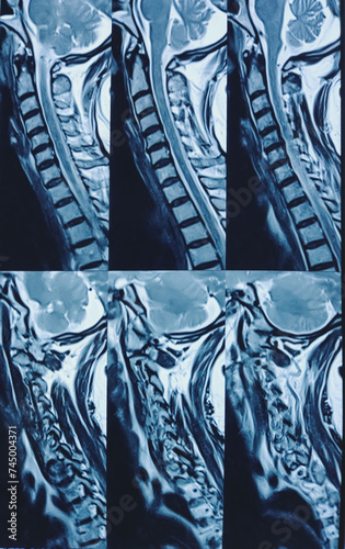MRI of Cervical Spine and screening. Cervical spondyloarthropathy, thecal sac indentation at C4-C5 and C5-C6 level, indentation with nerve roots compression at C5-C6 level. photo