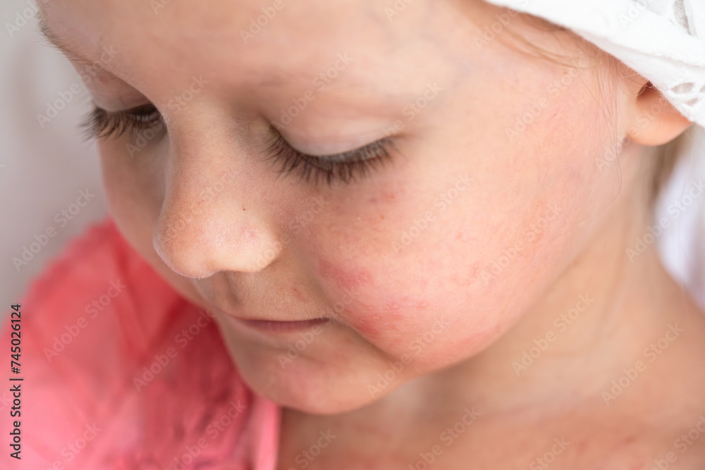 coxsackievirus, Singapore flu, skin rashes, blisters, viral infection