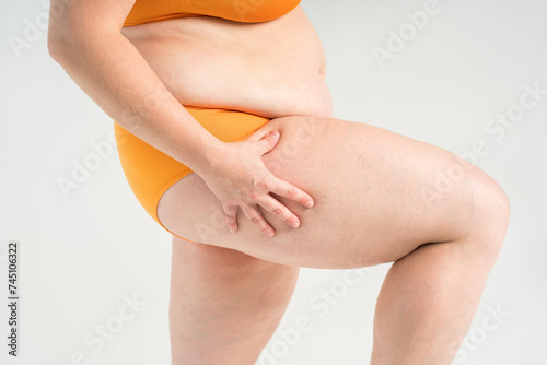 Overweight woman, fat hips, thighs and legs, obesity female body with cellulite and varicose veins on studio background