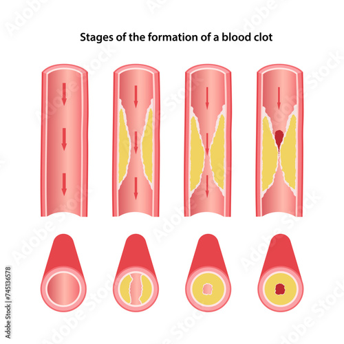 Stages of the formation of blood clot. Sectional drawing of an artery. Vector illustration in flat style isolated on white background