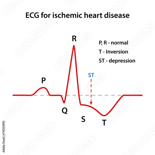 Diagram of the ECG for coronary heart disease. Heart cardiogram. Vector illustration in flat style