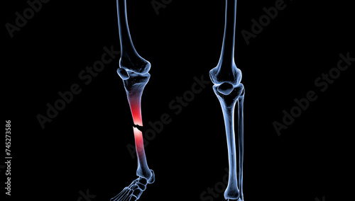 3D medical illustration of broken tibia