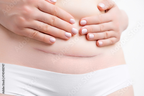 Woman holding her belly and demonstrates hypertrophic scar after c section.  photo