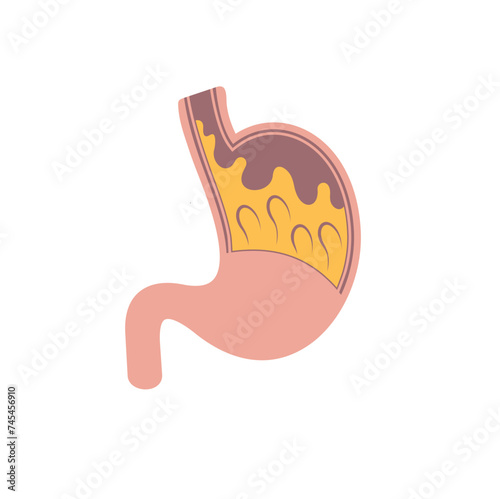 illustration of Gastroesophageal reflux disease or GERD.