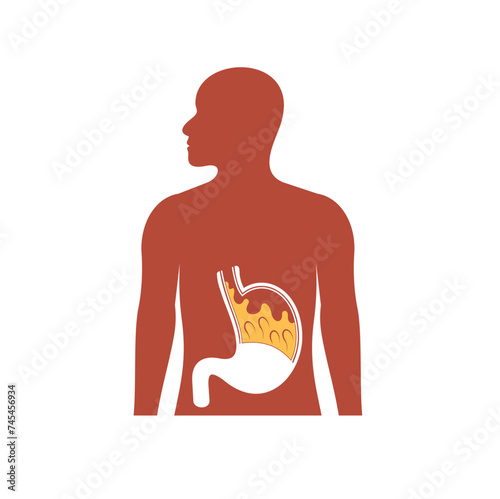 illustration of Gastroesophageal reflux disease or GERD.