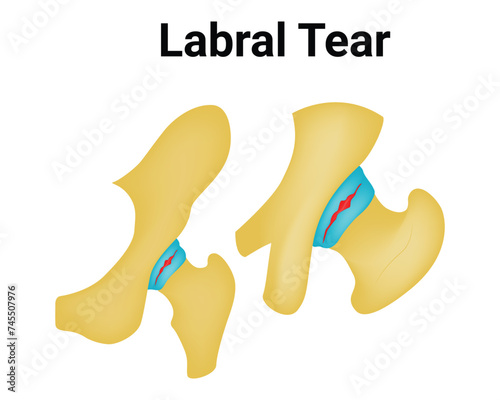 Labral Tear Science Design Vector Illustration Diagram