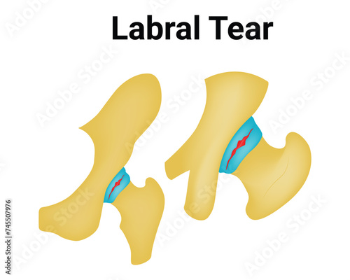 Labral Tear Science Design Vector Illustration Diagram photo