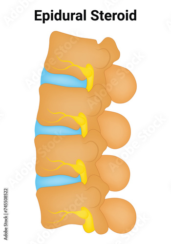 Epidural Steroid Science Design Vector Illustration Diagram