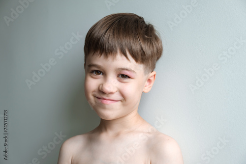 Portrait of happy beautiful joyful little 6 year boy with red swollen eye isolated on grey background. Positive kid looking at camera. Good mood. Copy space. Alive emotions. Concept of happiness