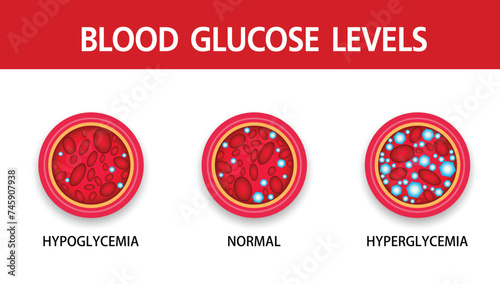 Hyperglycemia, High Blood Sugar and Diabetes ,obesity is a serious medical condition causes, vector design.