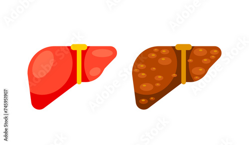 Healthy liver and liver cirrhosis disease. Human liver organ. Vector illustration