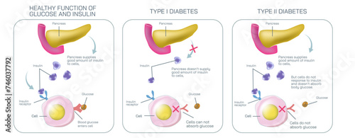 Difference between type one diabetes and type two diabetes. Where body cell do not absorb glucose to balance the insulin level vector illustration. Diabetes mellitus. Diabetes symptoms and prevention.