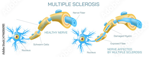 how neurotransmitter works? The process the brain neurons communicate each other anatomy vector illustration. Action potentials and synapses. multiple sclerosis formation. Motor neuron communication.