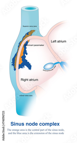 It is thought that the pacemaker cells of the sinus node can be distributed along the cristae terminalis of the right atrium in a wide area from the superior vena cava to the inferior vena cava. photo