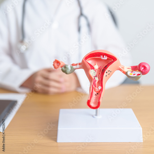 Doctor with Uterus and Ovaries anatomy model. Ovarian and Cervical cancer, Cervix disorder, Endometriosis, Hysterectomy, Uterine fibroids, Reproductive system, Pregnancy and health concept