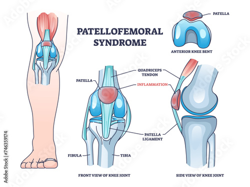 Patellofemoral pain syndrome as anatomical knee condition outline diagram, transparent background. Labeled educational scheme with leg kneecap patella part inflammation illustration.