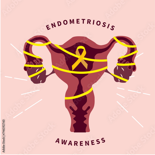 Uterus tied with yellow endometriosis ribbon