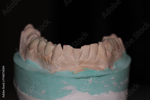 dental technician model fixed prosthesis ceramic wax up plaster crown ceramo ceramic CCM photo