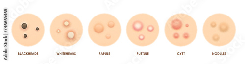 Body skin acne types, pimples and papules, pore inflammation and problems, vector icons. Face skin acne types, blackhead, pustule or whitehead, papule and cyst with nodules for skincare cosmetology