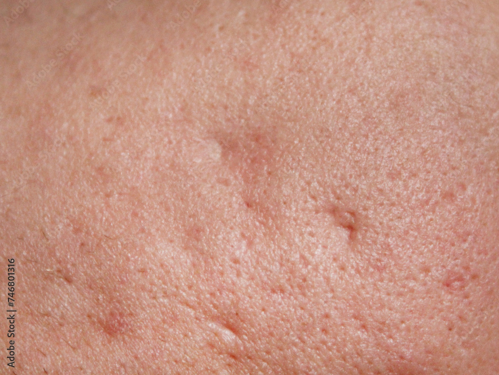 Texture of porous skin with traces of pimples and acne. Problem skin treatment concept. High quality stock photo.