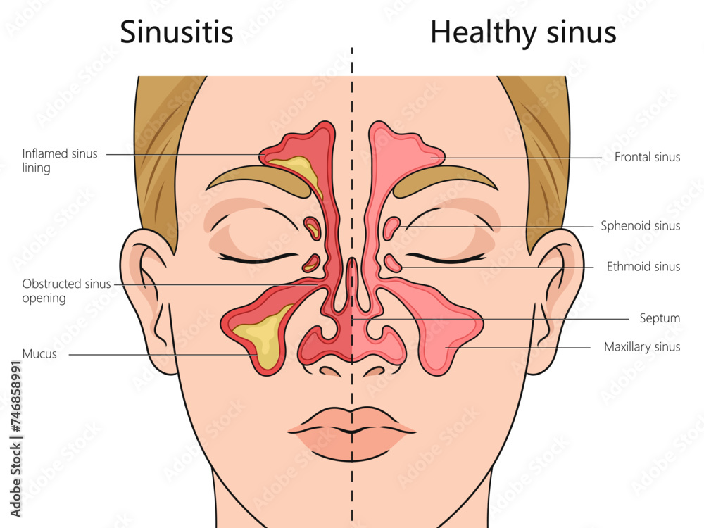 Sinusitis structure diagram hand drawn schematic vector illustration ...