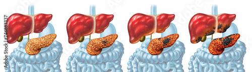 Tableau sur toile Pancreatic Cancer Stages concept and Pancreas disease as malignant tumor growth stage as a digestive gland with cancerous cells dividing and spreading to other organs