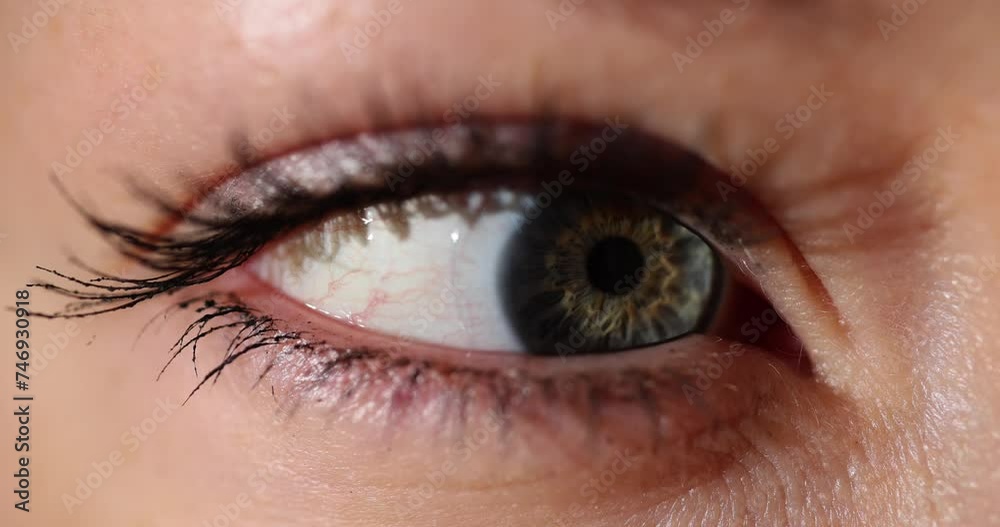 Closeup of a woman eye with visible bloodshot veins and watery eyelid and soft contact lens