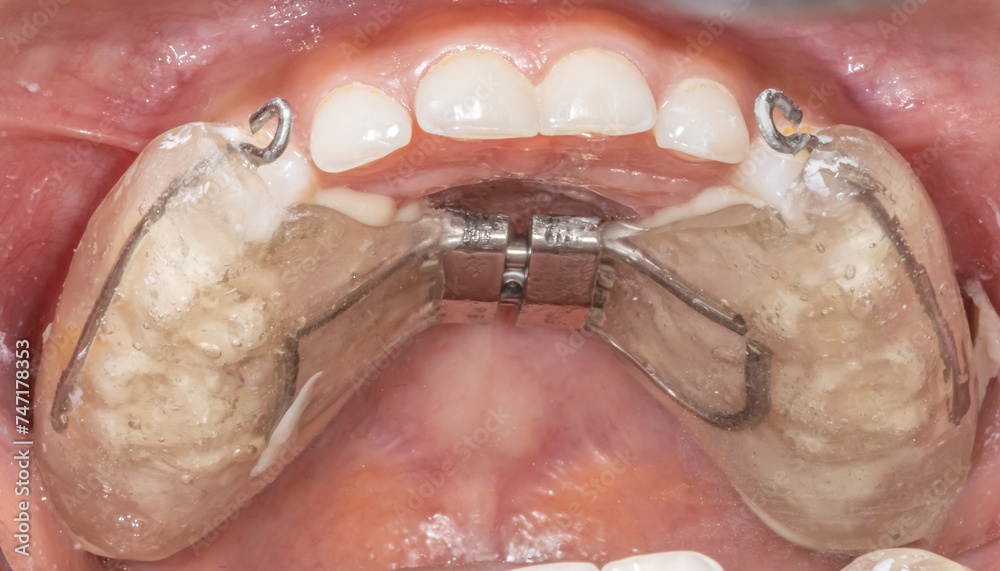 Palatal expander device sealed to widen the upper jaw in orthodontics