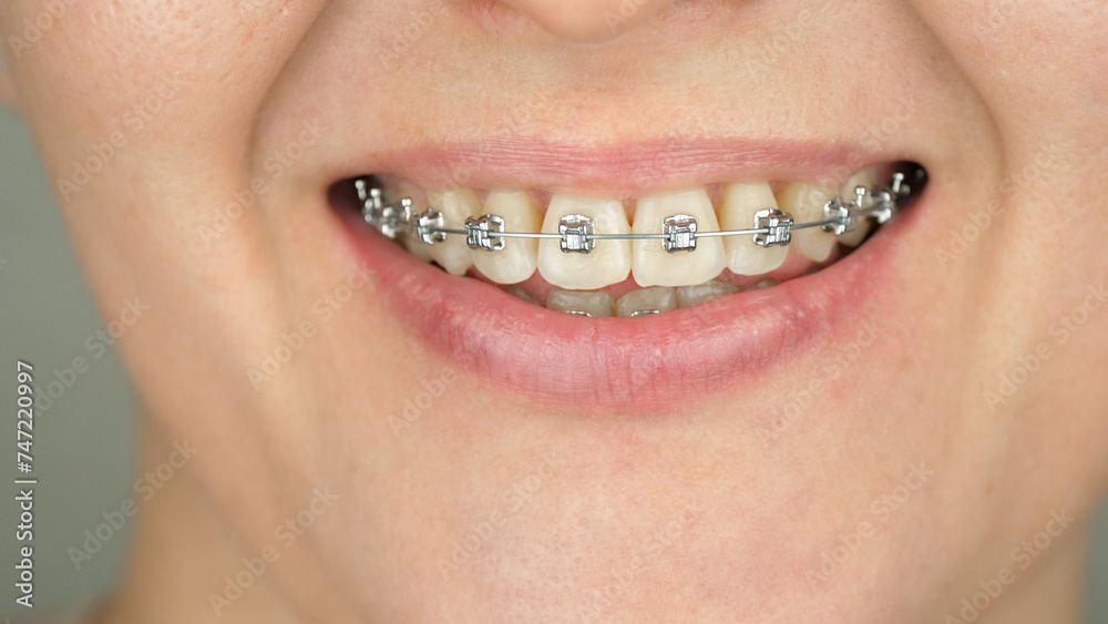 Obraz premium close-up smile. Braces, orthodontic construction on teeth. Dental health concept and bite correction. dental business