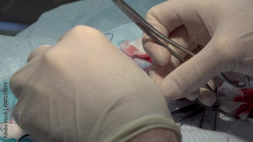 Doctor suturing wound with needle and self dissolving thread during a surgery. Doctor suturing wound with needle and self dissolving thread during a surgery.