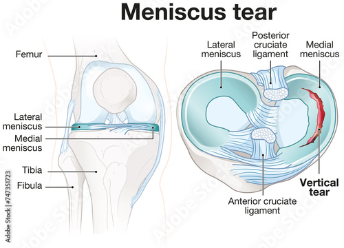 Meniscus tears. Medically labeled illustration