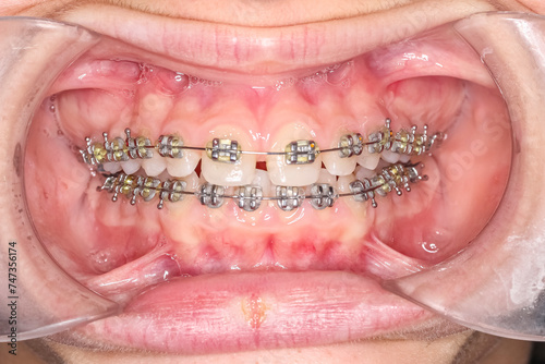Frontal view of dental arches in biting gap toothed teeth patient. Diastema gap between upper central incisors and cheeks and lips retracted with cheek retractor.