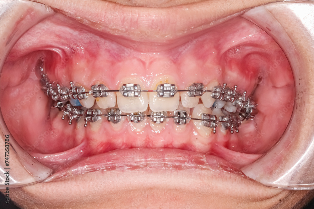 Frontal view of dental arches in biting teeth occlusion with blue resin